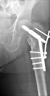 collumfractuur.001044