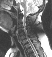 spinal cord injury