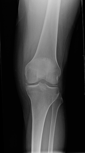 chondrocalcinosis1_0