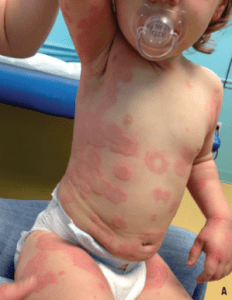 Urticarial-Multiforme-Picture