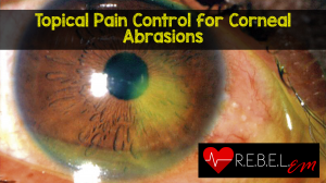 Corneal-Abrasions-300x168