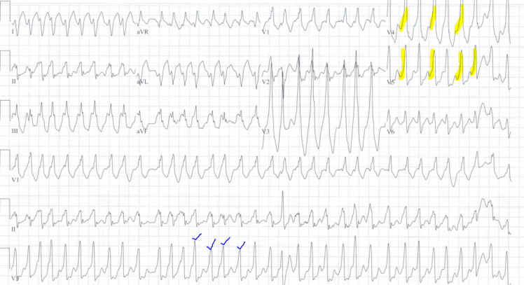 ecg wpw 3