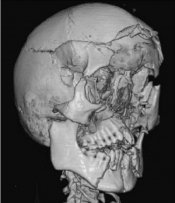 facial trauma