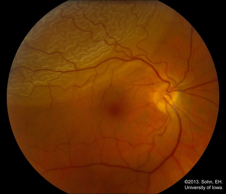 Retinal-Detachment-webeye.ophth_.uiowa_.edu_.jpg