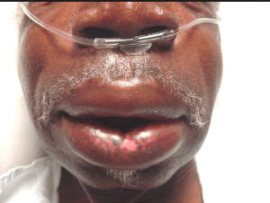 Angioedema-