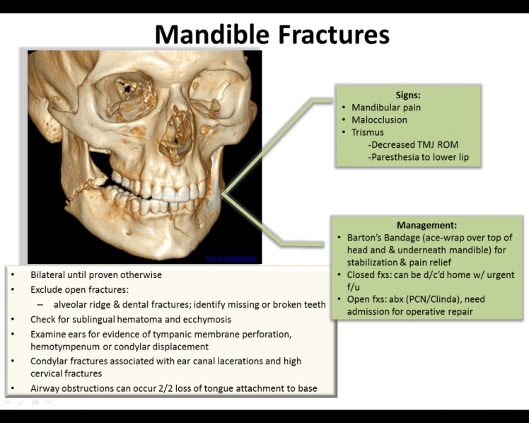 mandible fractures