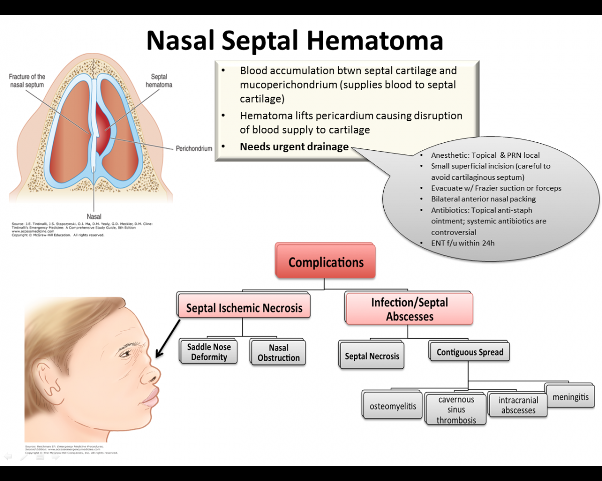 Nasal Septal Hematoma – Verpleegkundig specialisten Spoedeisende hulp