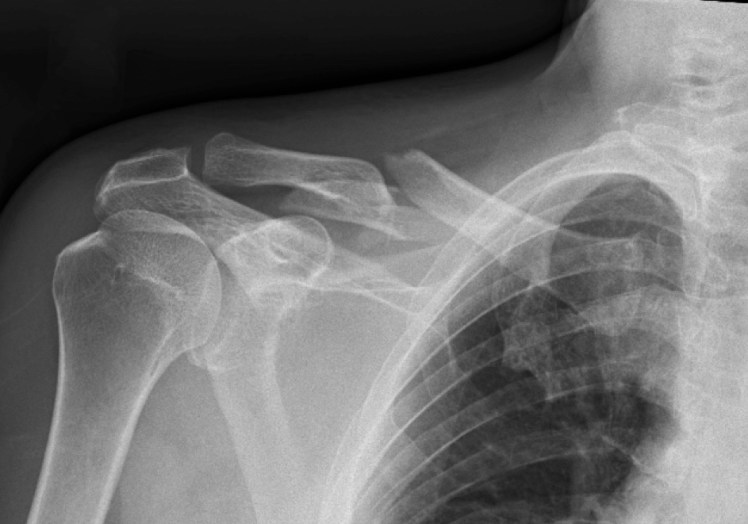 clavicle_0