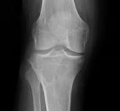 bone tumor1.jpg
