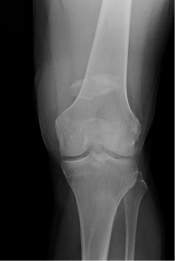 Patella1.jpg