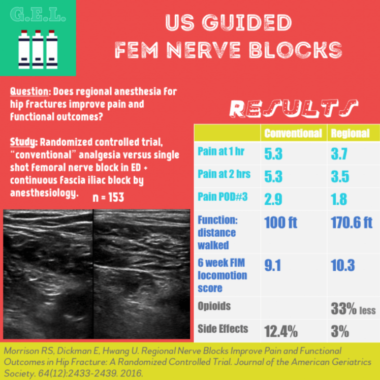 Fem-Nerve-Block-1024x1024.png