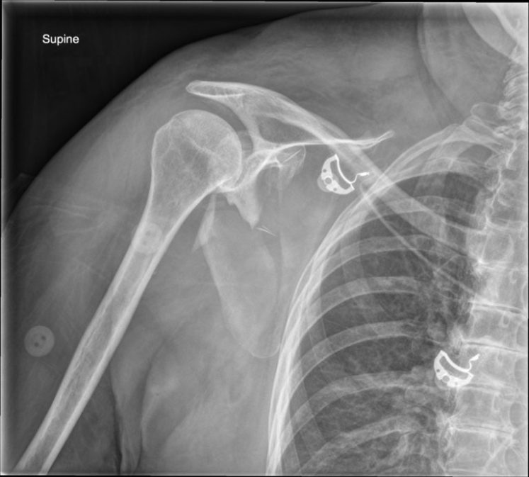 Scapula-Body-Fracture-768x692.jpg