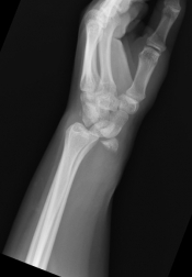 scaphoid2.jpg