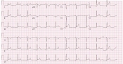 pericarditis.jpg