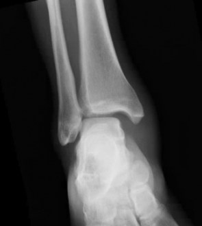APankle-324x362.jpg