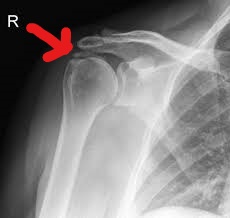 Inkedcalcific tendonitis_LI.jpg