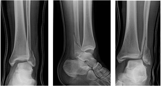 Bosworth-ankle-fracture-dislocation.jpg