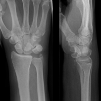 lunate-dislocation-xray.png
