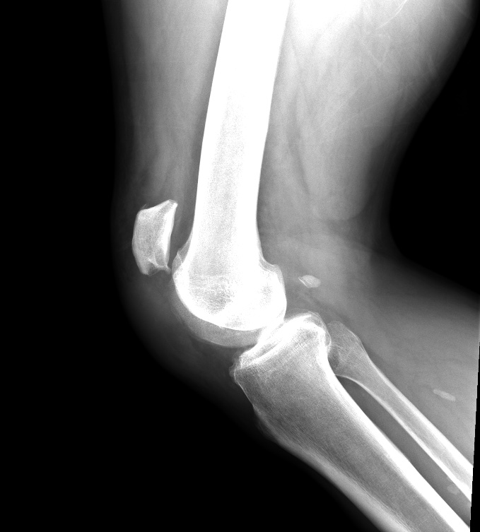 Patella tendon (2).jpg