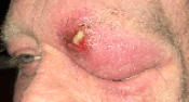 orbtial cellulitis.png