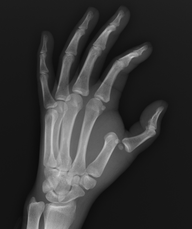 MCP dislocation